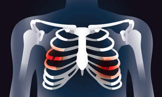 อาการปวดข้อและตึง - costochondritis สิ่งนี้จะส่งผลต่อคุณภาพชีวิตของคุณได้อย่างไร?
