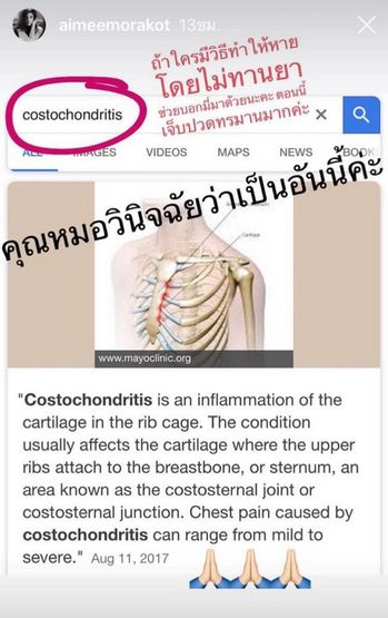 อาการปวดข้อและตึง - costochondritis สิ่งนี้จะส่งผลต่อคุณภาพชีวิตของคุณได้อย่างไร?