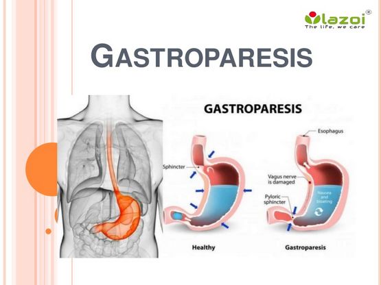 Gastroparesis