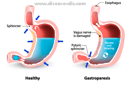 Gastroparesis